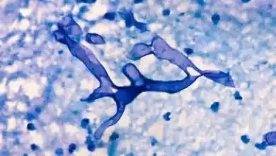 mucormycosis