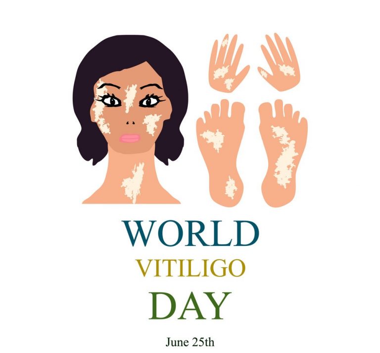 World Vitiligo Day Observer Voice