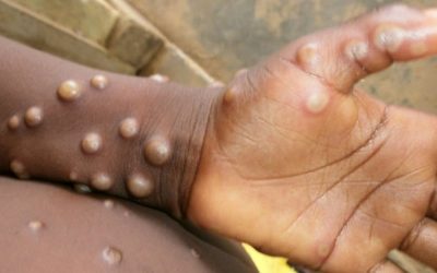 Monkeypox Q&A: how do you catch it and what are the risks? An expert explains  Ed Feil, University of Bath