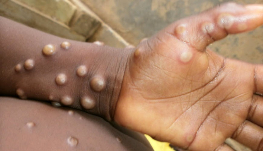 Monkeypox Q&A: how do you catch it and what are the risks? An expert explains  Ed Feil, University of Bath