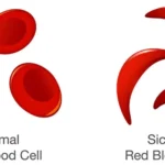 World Sickle Cell Awareness Day 2022