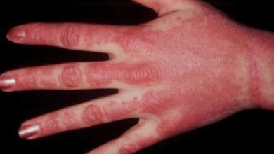 Dermatomyositis