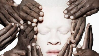 International Albinism Awareness Day