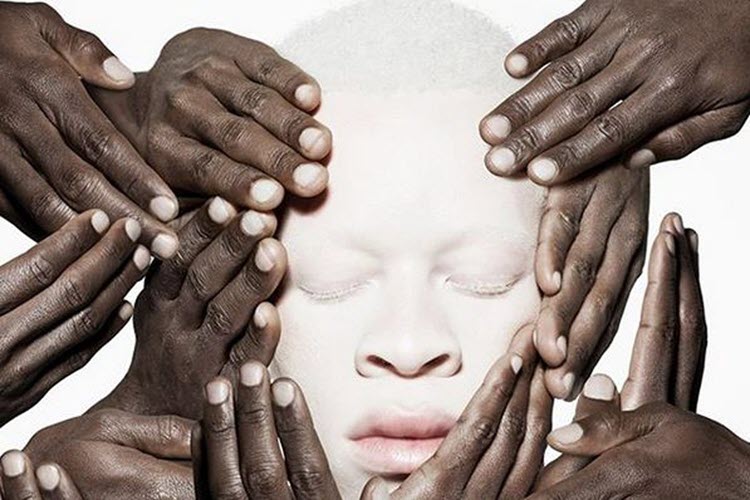 International Albinism Awareness Day