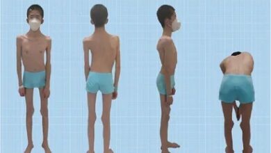 Nemaline Myopathy