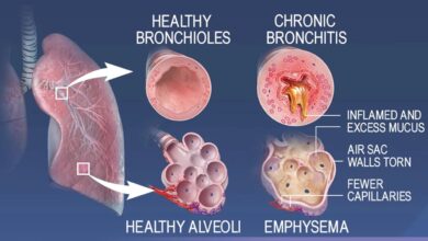 Chronic respiratory diseases