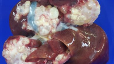 Echinococcosis