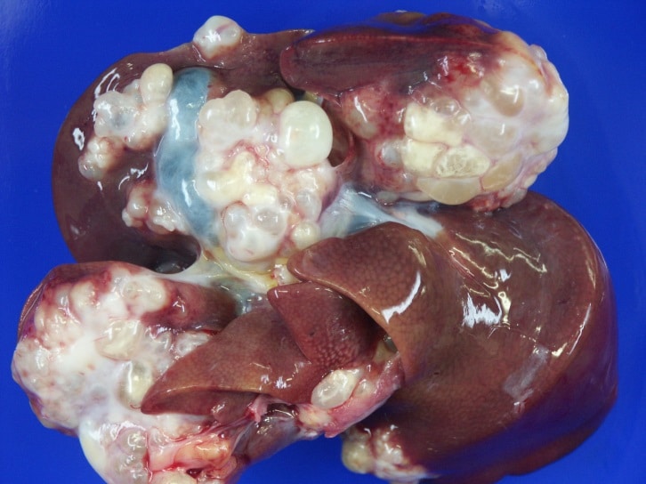 Echinococcosis