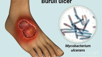 Buruli Ulcer