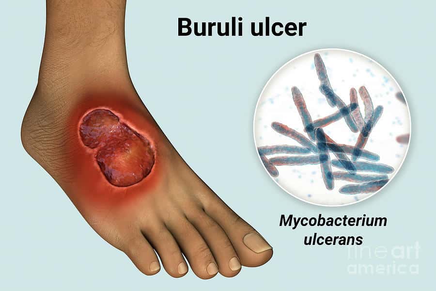 Buruli Ulcer