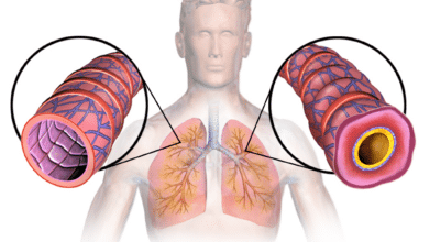 asthma