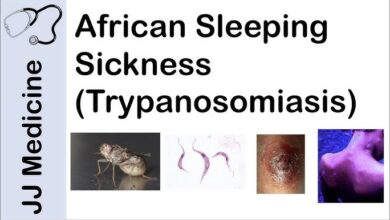 Human African trypanosomiasis (sleeping sickness)