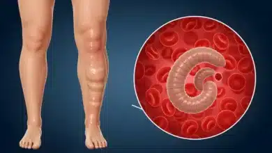 Lymphatic Filariasis