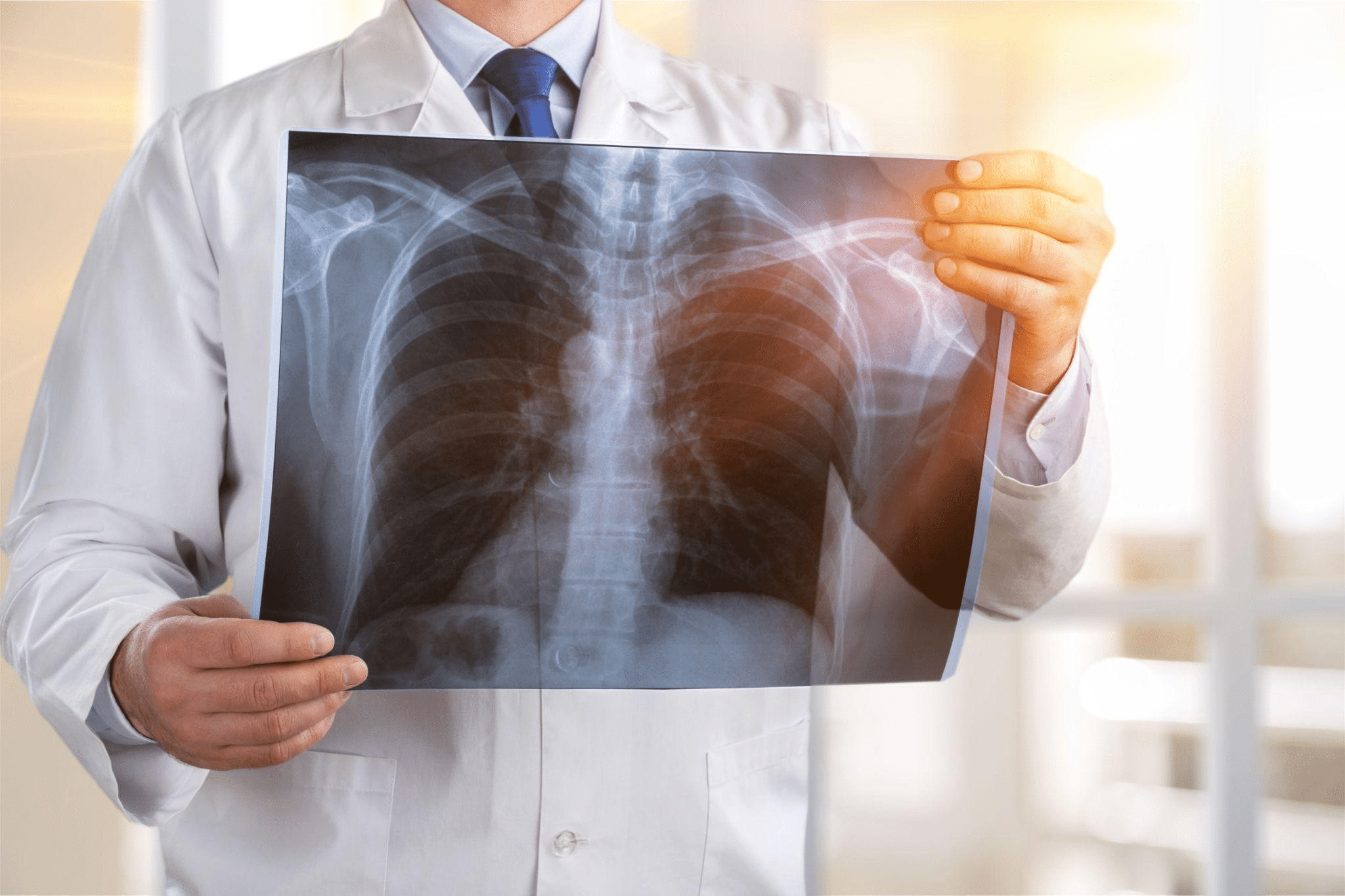 New Guidelines Unveiled for Lung Cancer Treatment in India