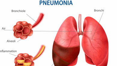 Pneumonia