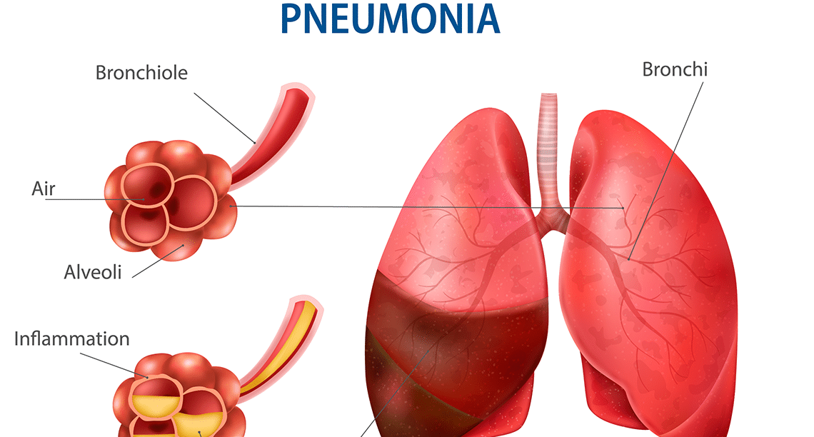 Pneumonia