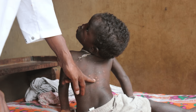 Neglected Tropical Diseases: The Hidden Illnesses Affecting 1.6 Billion People