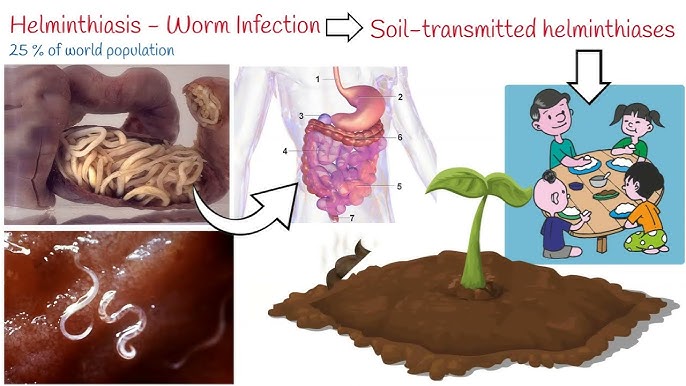 Microscopic image of soil-transmitted helminth parasites including roundworm hookworm and whipworm causing intestinal infections in endemic regions