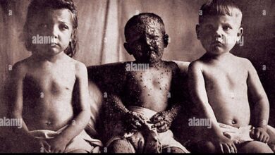 Historical photo showing smallpox eradication vaccination campaign WHO bifurcated needle demonstration in endemic region during 1970s