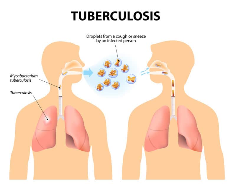 Microscopic view of Mycobacterium tuberculosis bacteria showing tuberculosis pathogen responsible for 1.23 million deaths in 2024