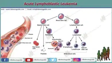 Acute Lymphoblastic Leukemia (ALL) in Adults