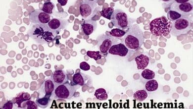 Acute Myeloid Leukemia