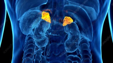 Adrenal Gland Cancer