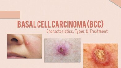 Basal Cell Carcinoma