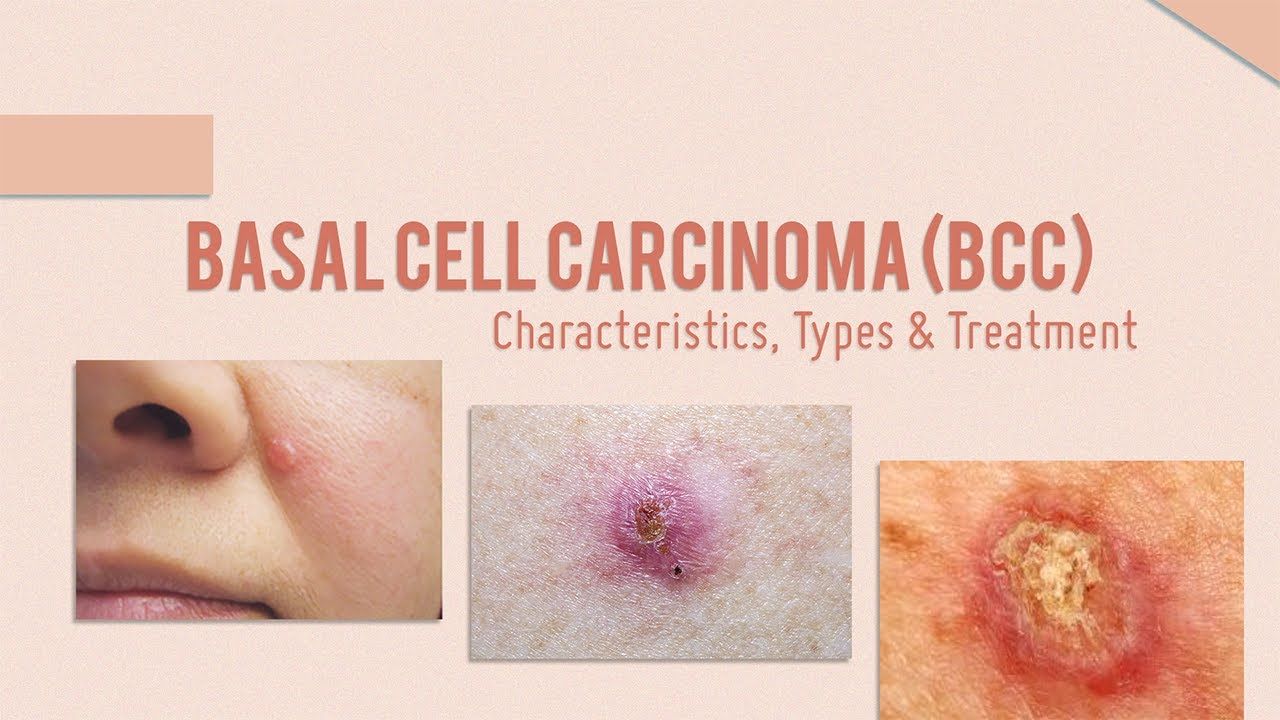 Basal Cell Carcinoma