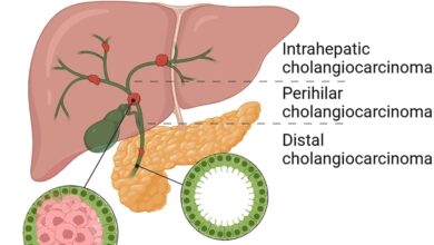 Bile Duct Cancer (Cholangiocarcinoma)