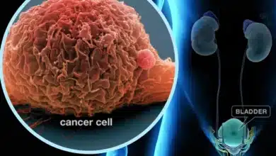 Bladder Cancer