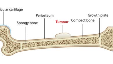 Chondrosarcoma: The Bone Cancer That Develops in Cartilage