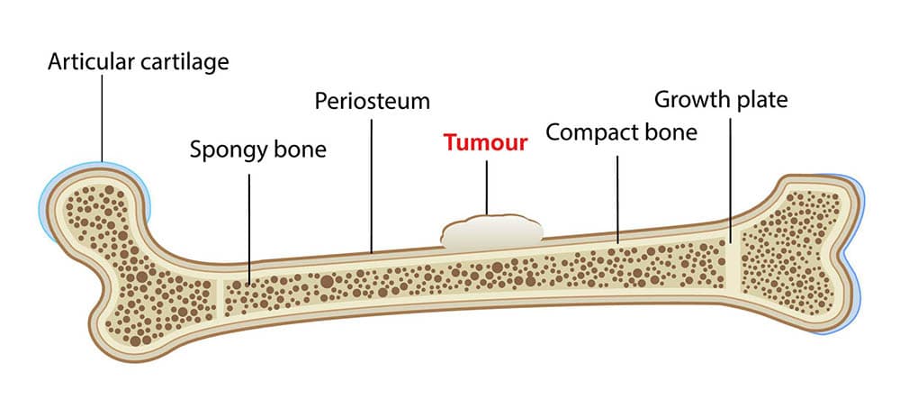 Chondrosarcoma: The Bone Cancer That Develops in Cartilage