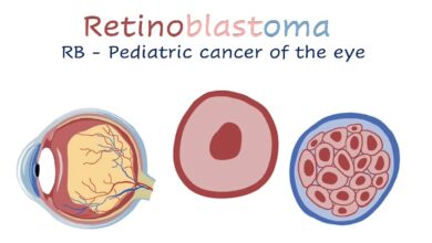 Retinoblastoma