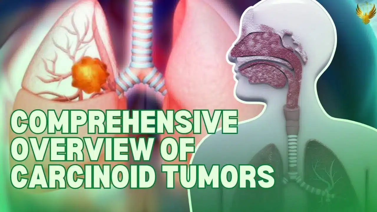 Carcinoid Tumors: Symptoms, Serotonin, and Carcinoid Syndrome Explained ...