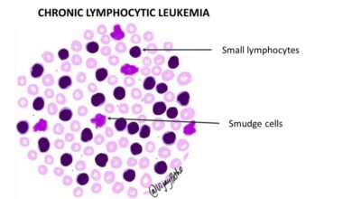 Chronic Lymphocytic Leukemia (CLL)