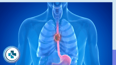 Esophageal Cancer
