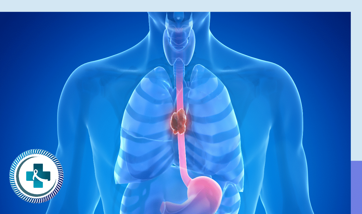 Esophageal Cancer