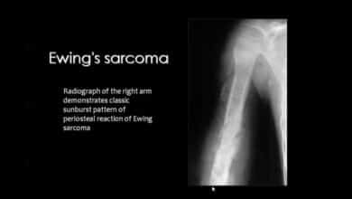 Ewing Sarcoma