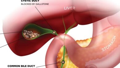 Gallbladder Cancer