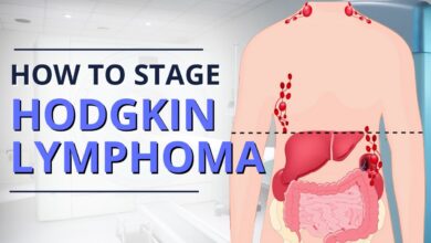 Hodgkin Lymphoma