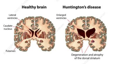 Huntington's Disease