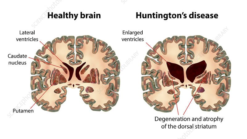 Huntington's Disease