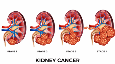 Kidney Cancer (Renal Cell Carcinoma)