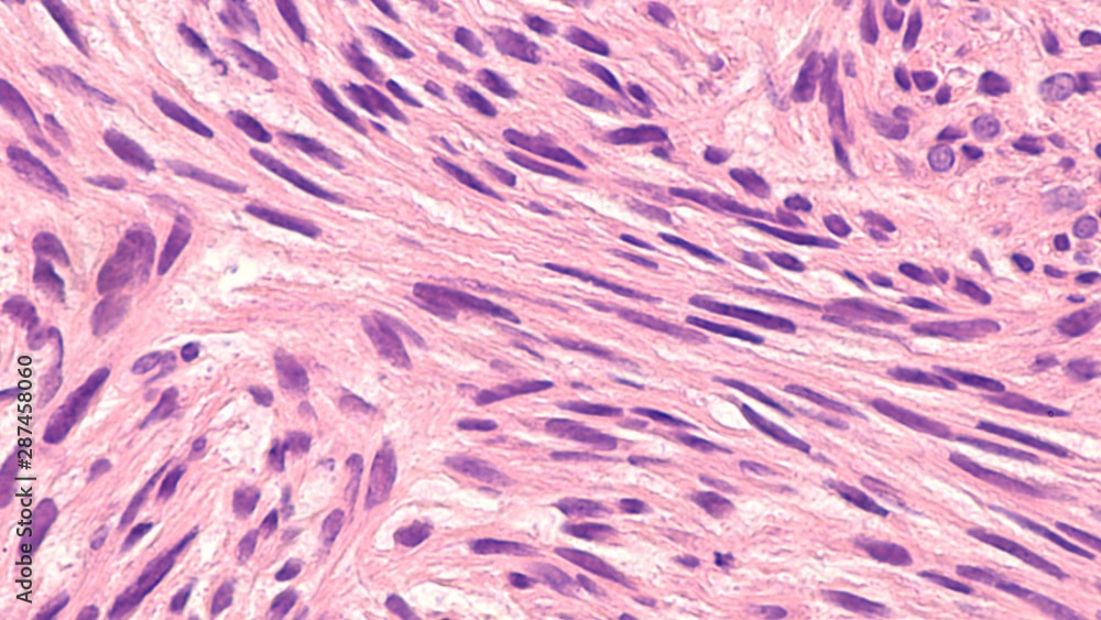 Leiomyosarcoma