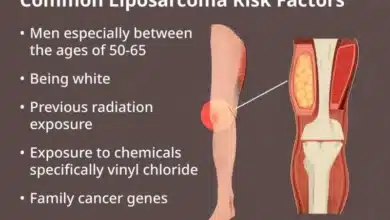 Liposarcoma
