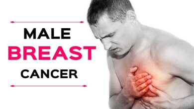 Male Breast Cancer