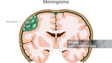 Meningioma