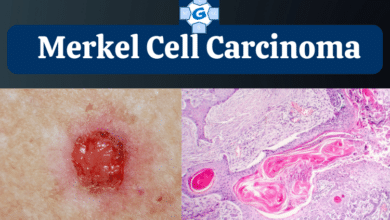 Merkel Cell Carcinoma