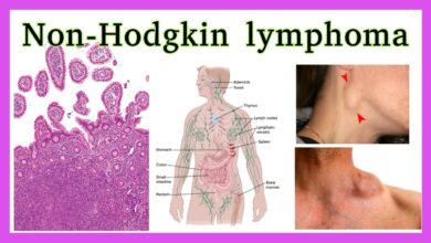 Non-Hodgkin Lymphoma